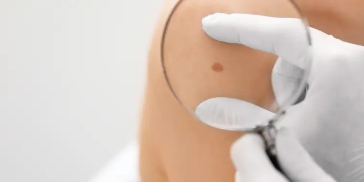 Skin Checks Brisbane QLD Skin Cancer Clinic